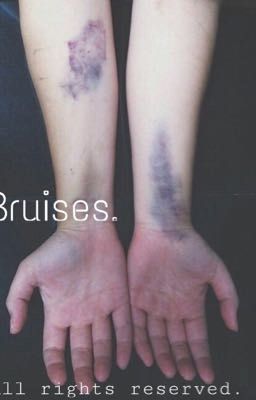 Bruises. •Phan•