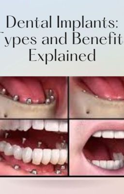 Discover the World of Dental Implants: Types and Benefits Explained