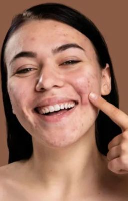 Guide to Safely Popping Blackheads: A Comprehensive Overview