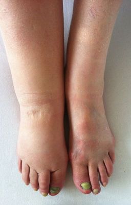 Lymphedema: Causes, Symptoms and Homeopathic Treatment