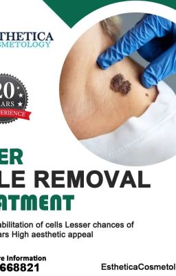 Mole Removal Services in Mohali - Esthetica Cosmetology