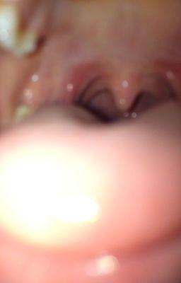 Please Help: is this strep throat?